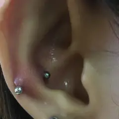 Zaczerwienienie i obrzęk wokół kolczyka w uchu, prawdopodobnie po zabiegu snug piercing.