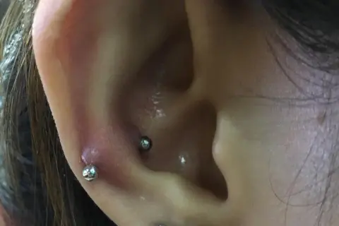 Zaczerwienienie i obrzęk wokół kolczyka w uchu, prawdopodobnie po zabiegu snug piercing.
