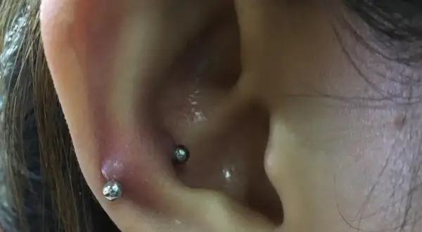 Zaczerwienienie i obrzęk wokół kolczyka w uchu, prawdopodobnie po zabiegu snug piercing.