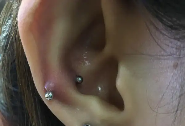 Zaczerwienienie i obrzęk wokół kolczyka w uchu, prawdopodobnie po zabiegu snug piercing.